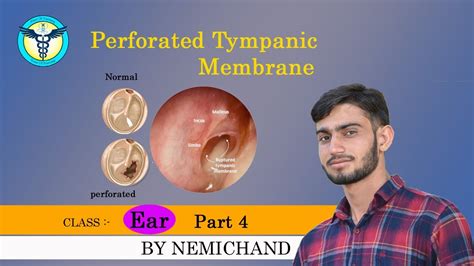 Perforated Tympanic Membrane Treatment