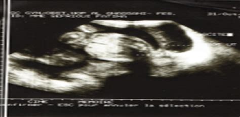 Obstetric ultrasound image showing a pregnancy at 23 weeks of... | Download Scientific Diagram