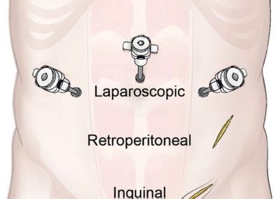 Mind the Gap: Varicocele, Surgery & Gonads (Again) — The Fabled Child