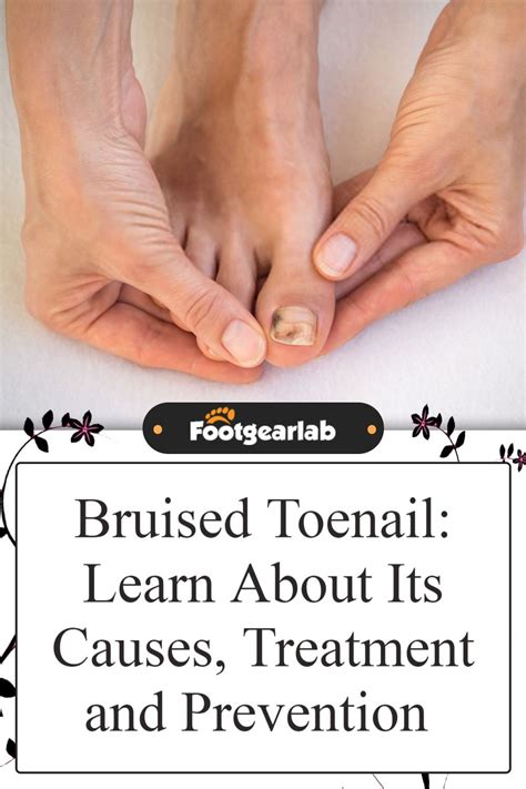 Bruised toenail learn about its causes treatment and prevention – Artofit