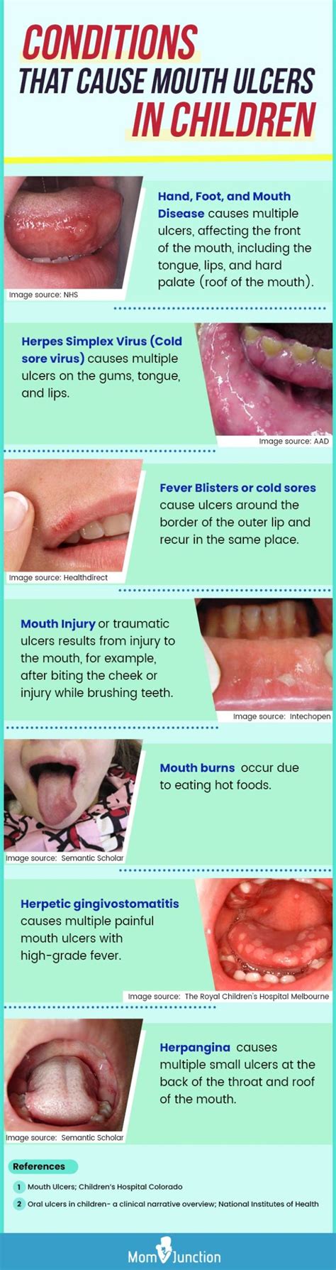 Multiple Canker Sores Under Tongue