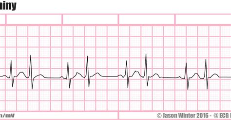 ECG Educator Blog : Atrial Bigeminy