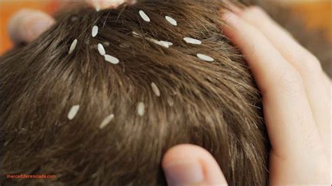 Head Lice Eggs In Hair - Caraway Seeds Health Benefits