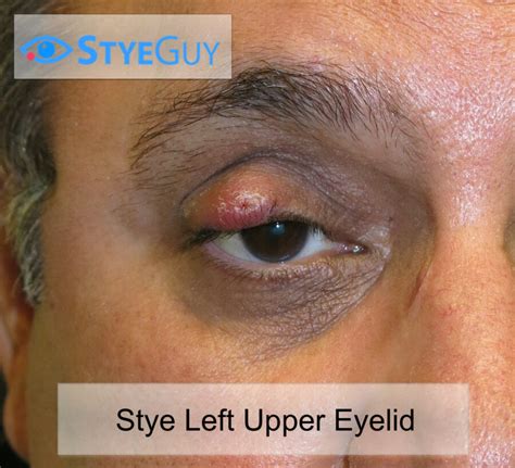Stye | StyeGuy | Get Fast Treatment For A Stye On An Upper Eyelid