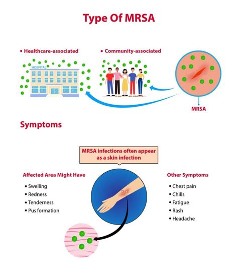Top 5 Facts about MRSA Strain