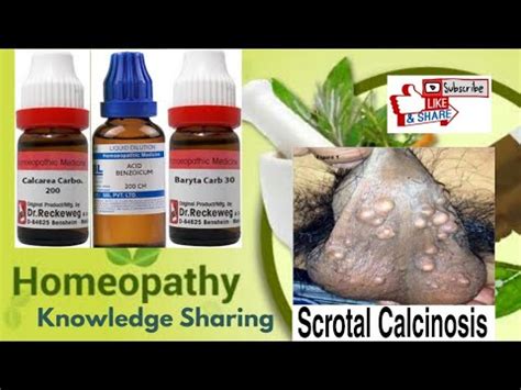 Scrotal Calcinosis | Homeopathic Medicine | scrotal calcinosis symptoms ...