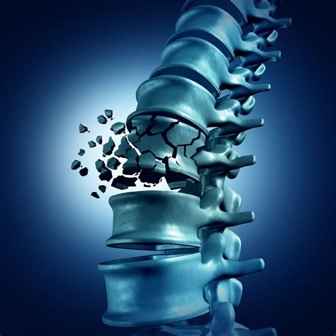 Burst Fractures and Treatment Options - Spine Center of Texas