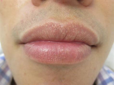 Tips to Prevent and Treat Fordyce Spots on Lips