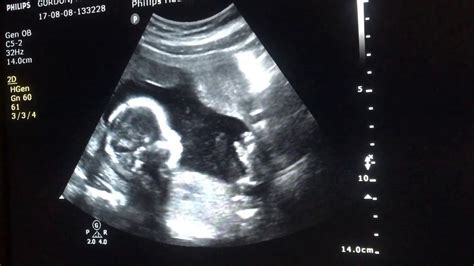 Ultrasound of baby movements at 19 weeks! - YouTube