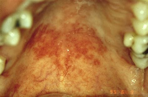 Erythematous candidiasis