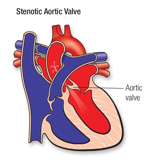 Aortic Valve Stenosis (AVS) and Congenital Defects | American Heart Association