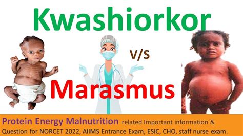 10 Differences Between Kwashiorkor And Marasmus, 41% OFF