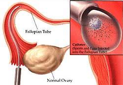 A complete guide of Gamete Intrafallopian Transfer (GIFT) and zygote intrafallopian transfer ...