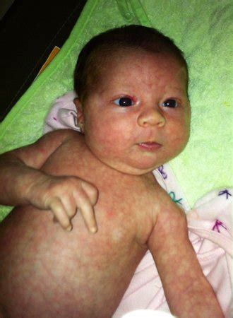 Mottled Skin * pic included | BabyCenter