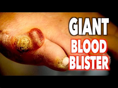 Blister After Wart Is Frozen