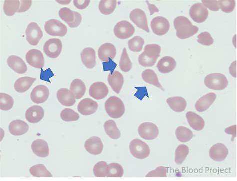 Teardrop Cells • The Blood Project