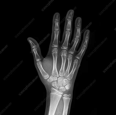 Xrays Of Broken Wrist