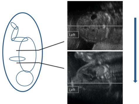 Situs inversus: In a cephalic presentation with the fetal spine to the... | Download Scientific ...