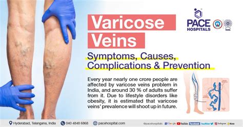 Varicose Veins – Symptoms, Causes, Complications and Treatment