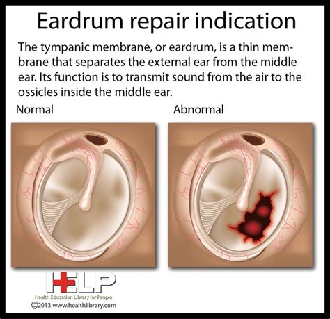 Eardrum Repair Indication