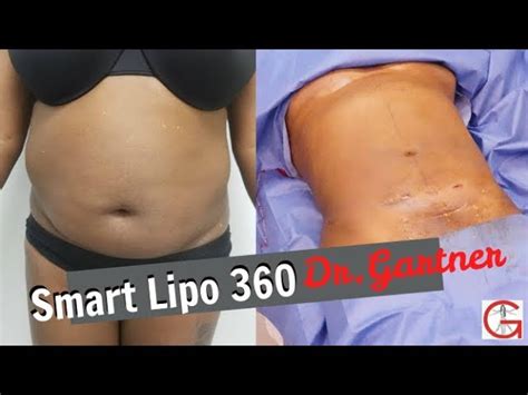 What Is Smart Lipo And How Much Does It Cost | Sitelip.org