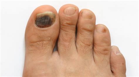 Natural Remedies for onychomycosis (Nail fungus) - Go Lifestyle Wiki