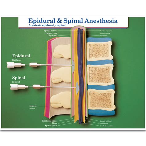 Buy Epidural & Spinal Anesthesia Chart Online at desertcartSri Lanka