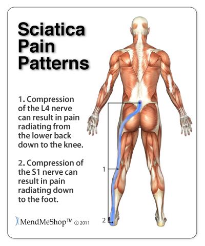 Sciatica Overview