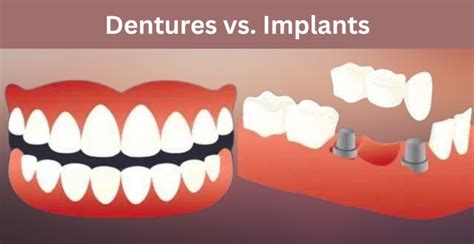 Dentures vs. Implants: Which is Better? - Best Health N Care