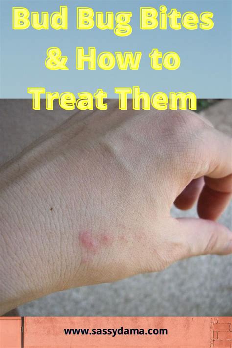 How to Effectively Treat Bed Bug Bite & Infestation | Bed bug bites ...