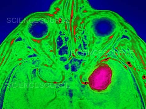 Photograph | Neuroma, MRI | Science Source Images