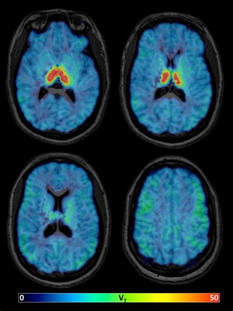 New nuclear medicine tracer will help study the aging brain