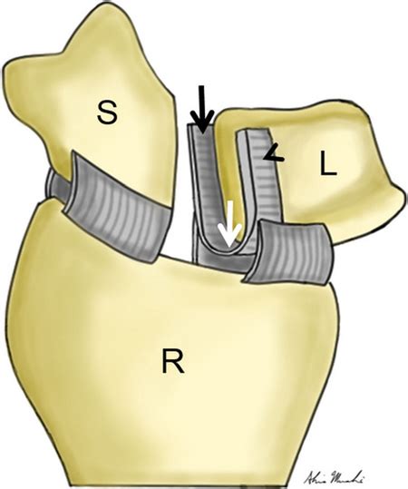 Scapholunate Ligament - Physiopedia