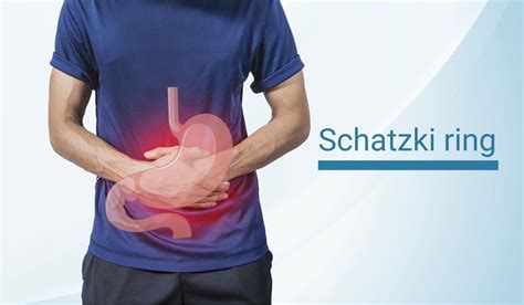 Schatzki Ring – Symptoms, Cause, Diagnosis & Treatment