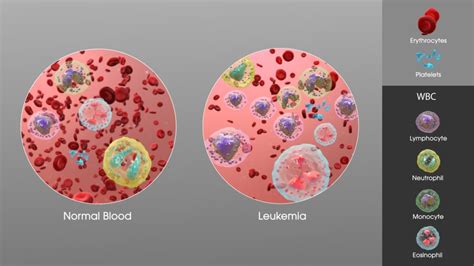 Leukemia - Types, Causes, Symptoms, Diagnosis, Treatment, Prevention ...