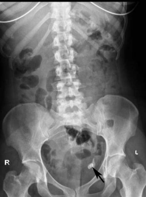 Ovarian Cystic Teratoma Ultrasound