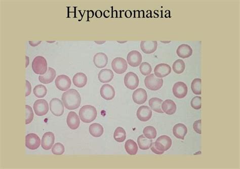 Hypochromasia: Definition, Causes, Symptoms and Treatment