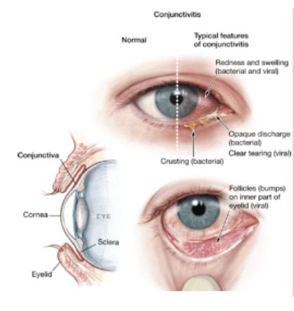 Eye Diseases: List of Common Eye Disorders