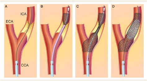Figure 3 from Carotid artery stenting vs. endarterectomy. | Semantic Scholar
