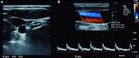 Normal mid common carotid artery duplex ultrasound images in both short ...