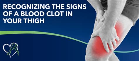 Recognizing the Signs of a Blood Clot in Your Thigh