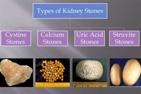 Types of Kidney Stones - Dr. Irfan Shaikh | Urolife Clinic, Pune