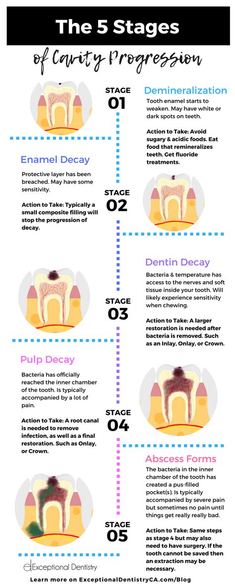 5 Stages of Cavity Progression | Healthy Teeth #health | Dental ...