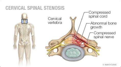 Mayo Clinic Q and A: Treating cervical spinal stenosis - Mayo Clinic News Network