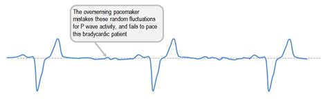 Transcutaneous Pacing - Code One CPR Training