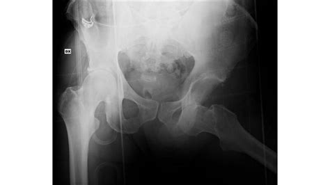 Hip Dislocation: Symptoms, Treatments, Causes, and More