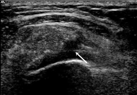 Complete Full Thickness Supraspinatus Tear