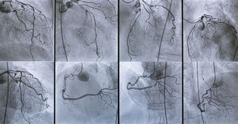 Coronary Angiography: Procedure, Side-Effects & FAQs