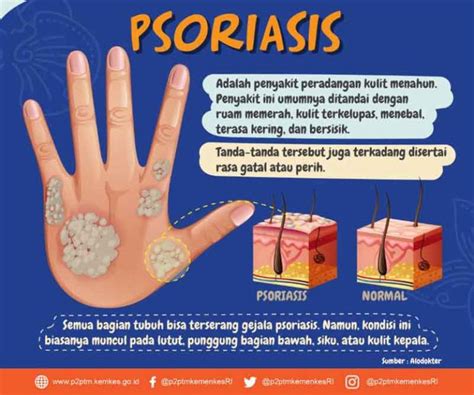 Apa Itu Psoriasis? Apa Gejala dan Penyebabnya?