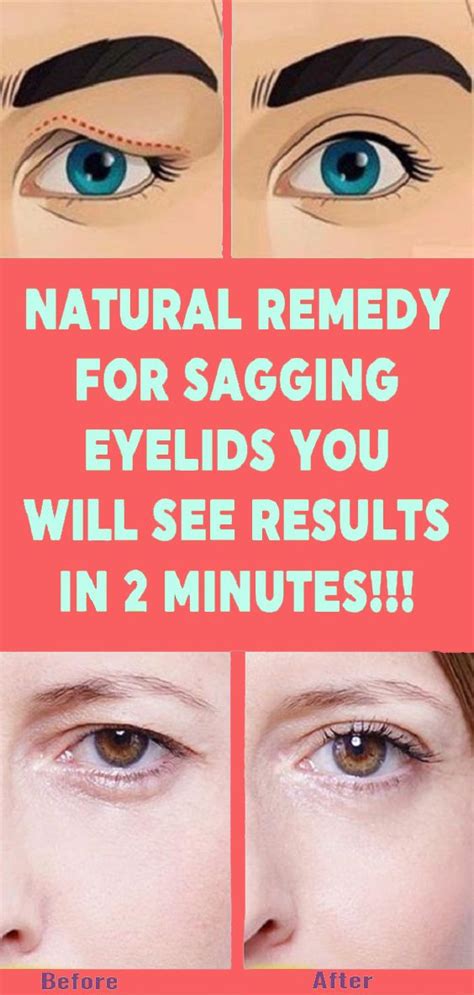 Natural Remedy for Sagging Eyelids You Will See Results In 2 Minutes!!! - Healthy Lifestyle